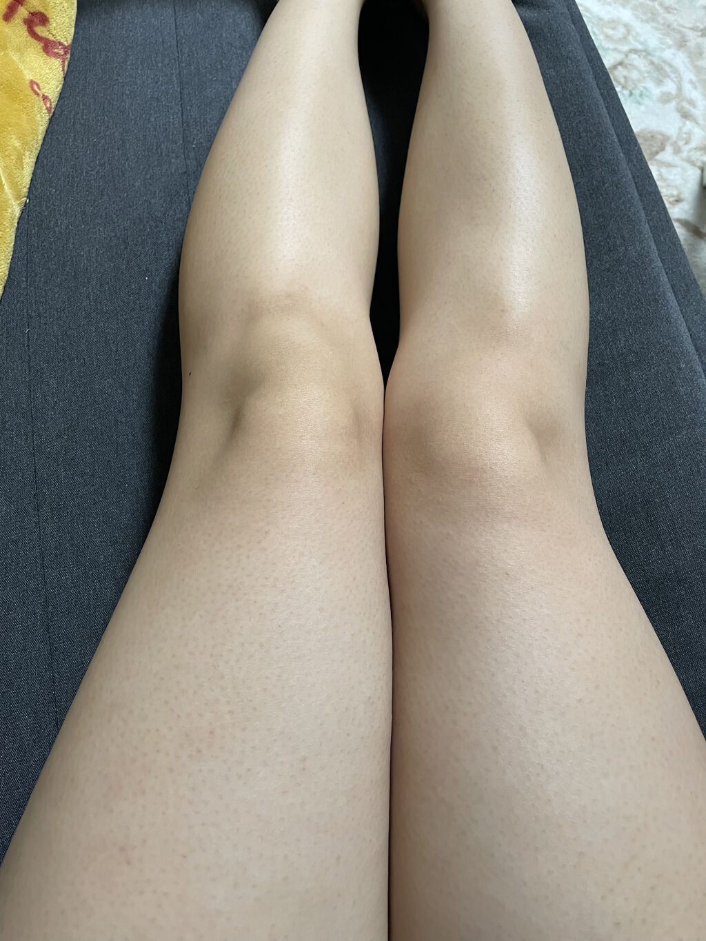 新しいコレクション 足 白い 斑点 むくみ 足 白い 斑点 むくみ