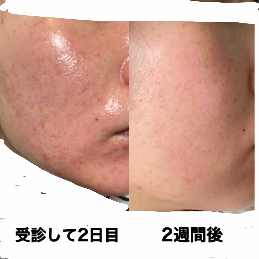 ベピオゲル 医薬品 の口コミ こんばんは 皆さん自宅待機 楽しんでますか By Amin 敏感肌 30代前半 Lips