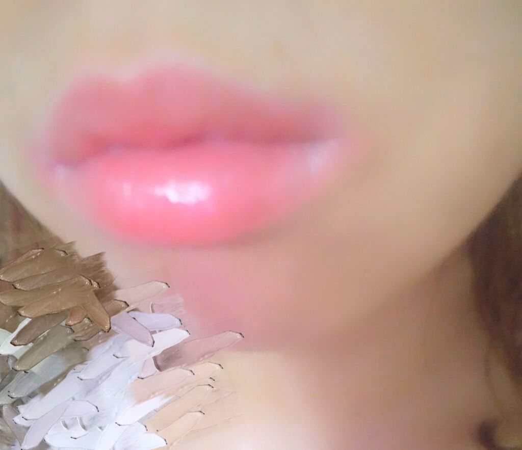 唇のヒアルロン酸の腫れや痛みは 気になるダウンタイムを体験談でご紹介 ツツイ美容外科 大阪 心斎橋