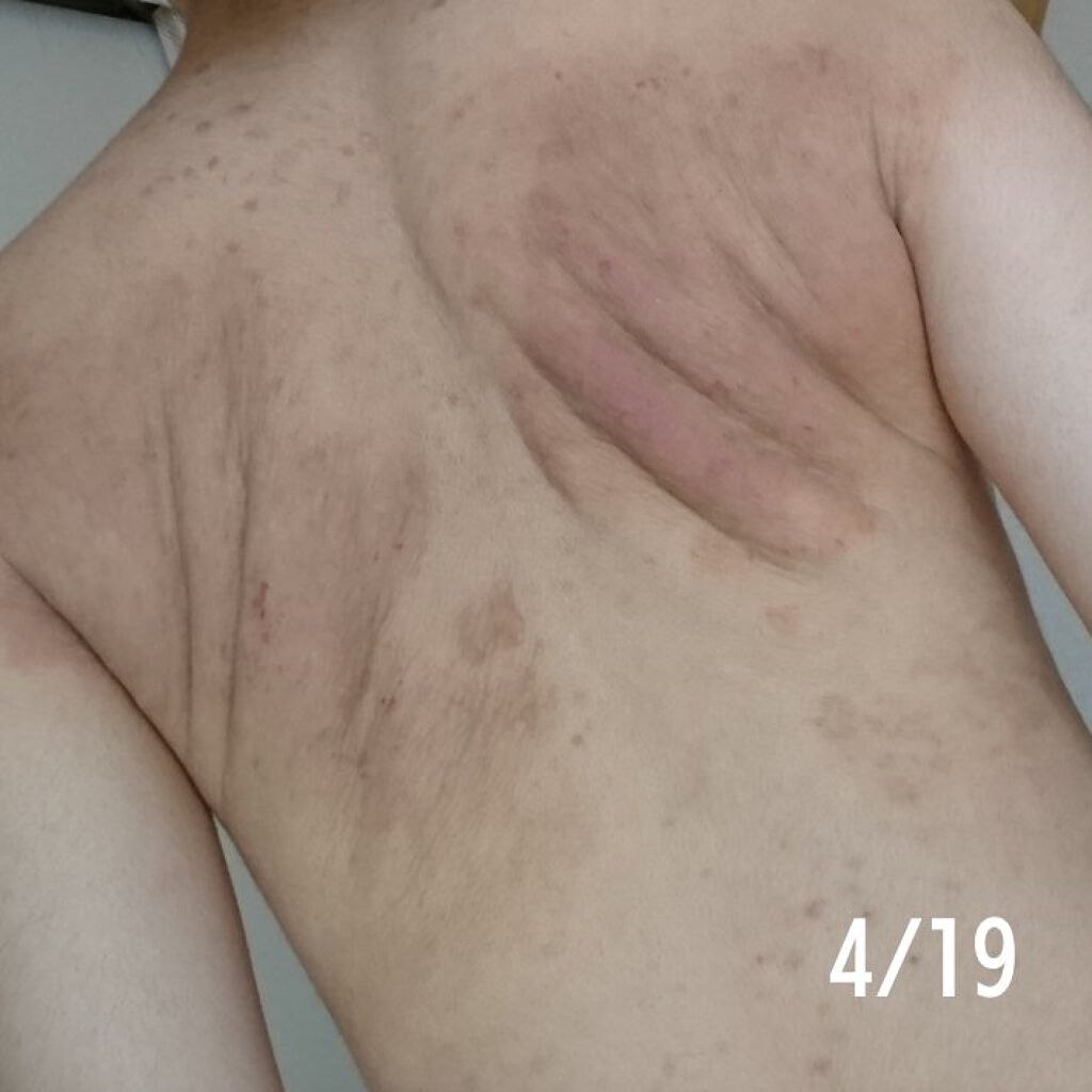 メンタームｅｘプラスクリーム 医薬品 メンタームを使った口コミ こちらも久しぶりの投稿です 炎症後色素沈着 By いー 脂性肌 代前半 Lips