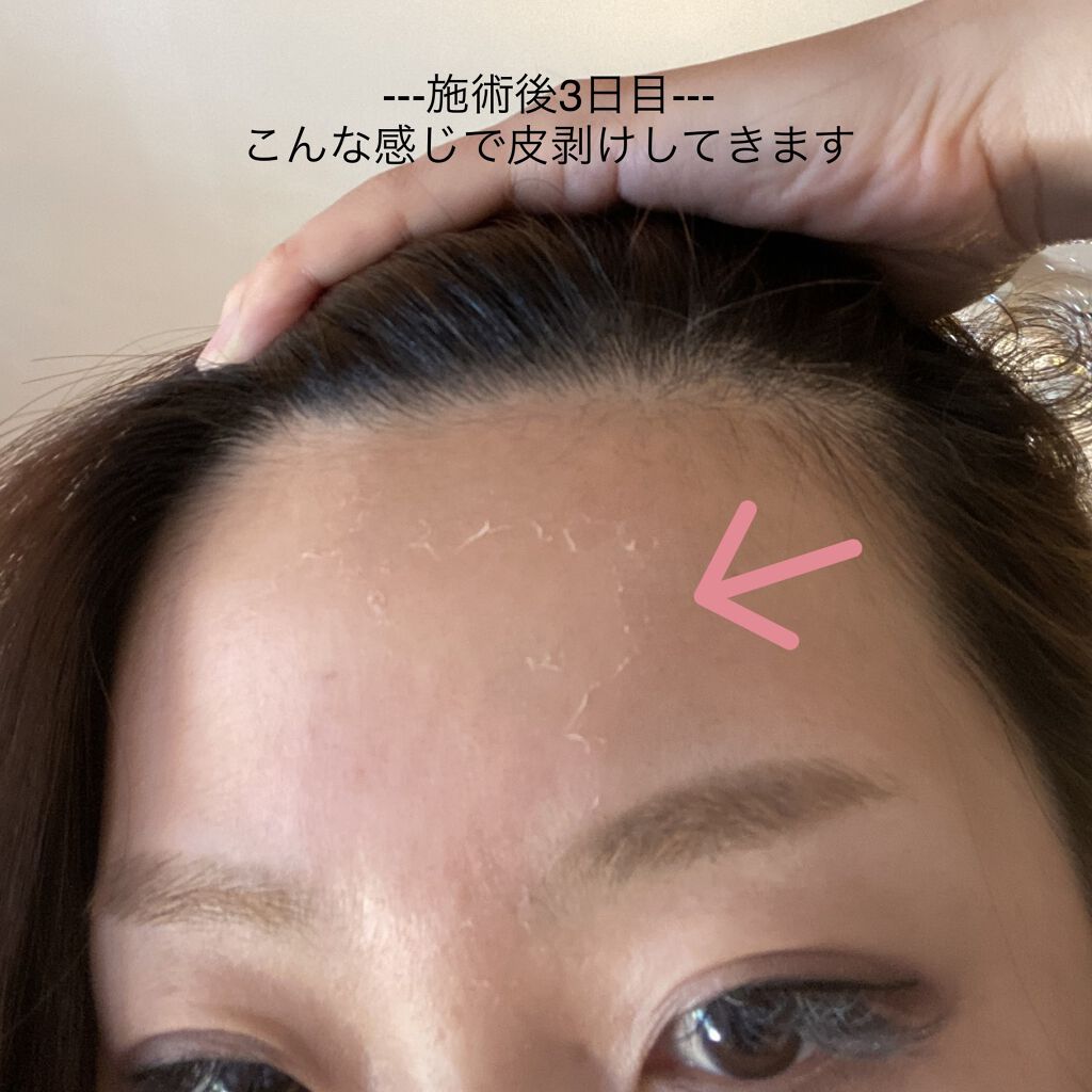 ボタニカルピーリングパウダー ベースジェルlevel1 Botanical Peelの口コミ 混合肌におすすめのピーリング ニキビ肌 ニキビ跡の改 By Maacosme 混合肌 30代前半 Lips