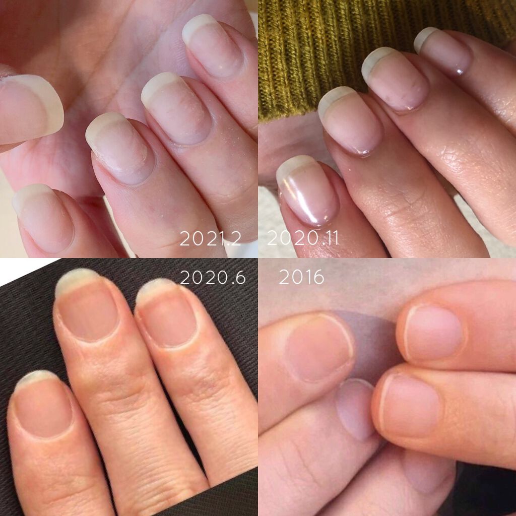 ビューティーチャージ アトリックスを使った口コミ 育爪経過報告 1月 2月 もう3月だけど By てらお 敏感肌 代後半 Lips