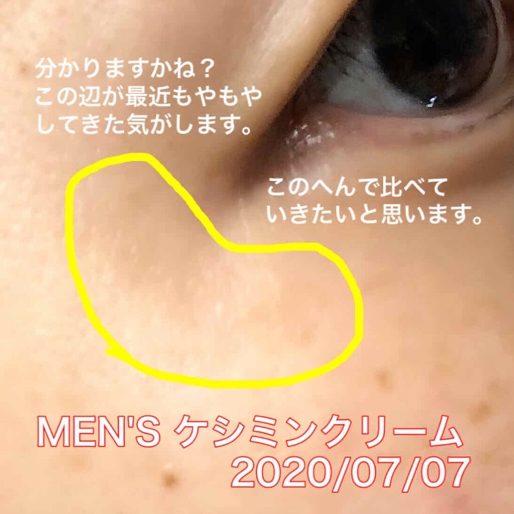 Men S ケシミン クリーム ケシミンの効果に関する口コミ 画像３ ４枚目に加工なしのシミ部分が出て By Gaho がほ 敏感肌 Lips