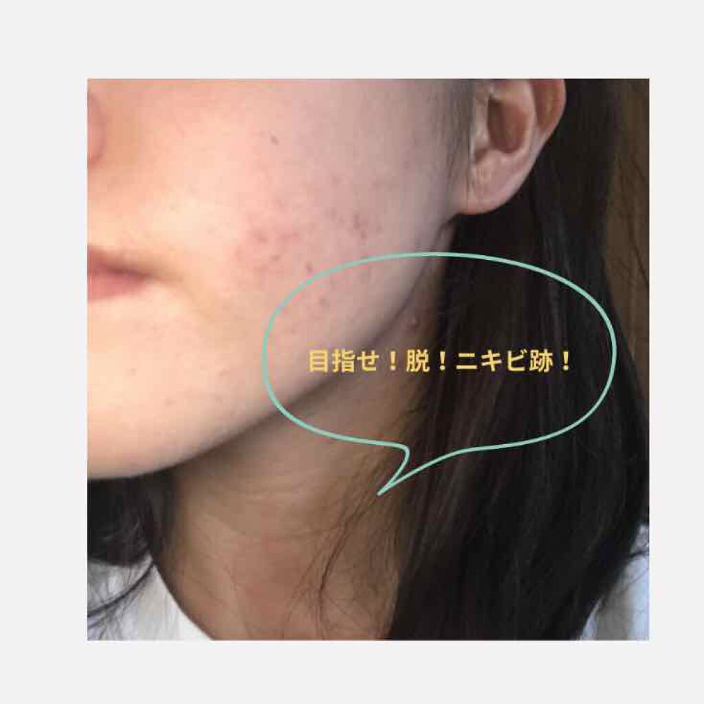 Mt クレンジング ジェル Mtメタトロンを使った口コミ フェイスラインのニキビ跡と顔全体の毛穴が気 By つねにねむい 混合肌 代前半 Lips