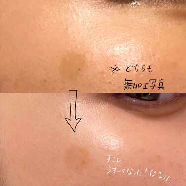 メラノフォーカスｖ Hakuの効果に関する口コミ 敏感肌におすすめの美容液 シミの記憶をゼロ化へ By アン 普通肌 30代後半 Lips