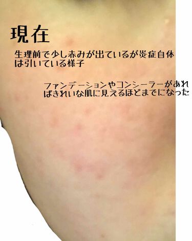 明色 美顔水 薬用化粧水 明色化粧品を使った口コミ 閲覧注意です 2枚目の画像にある写真 By 混合肌 10代前半 Lips