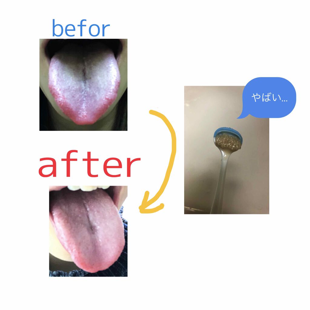 Nonio 舌クリーナー Nonioを使った口コミ 2枚目閲覧注意 舌が歯磨きしても汚れが落 By Rantyann 乾燥肌 代前半 Lips