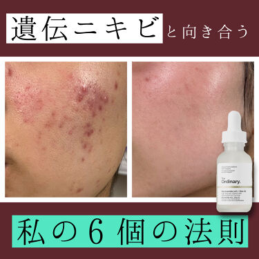 Niacinamide 10 Zinc 1 The Ordinaryのリアルな口コミ レビュー Lips