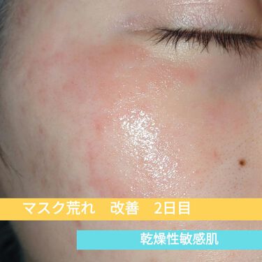 カユピット 非ステロイド 第2類医薬品 メンソレータムのリアルな口コミ レビュー Lips