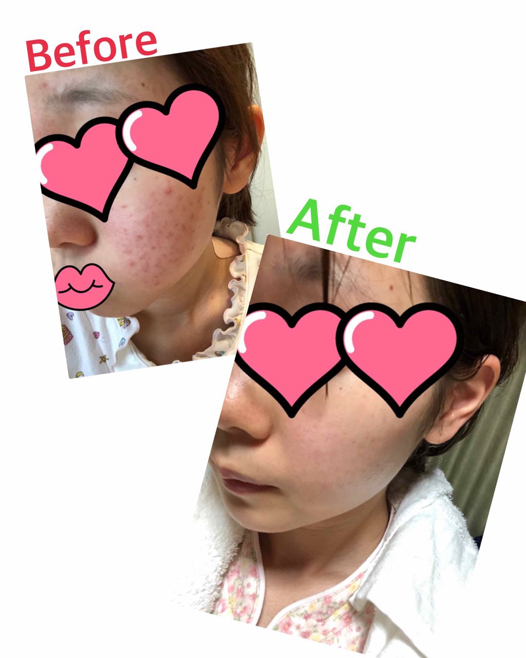 スキンケア方法 極潤 ヒアルロン液 旧 肌ラボの使い方 効果 今回は今まで1番反響を By なーちゃん 乾燥肌 代前半 Lips