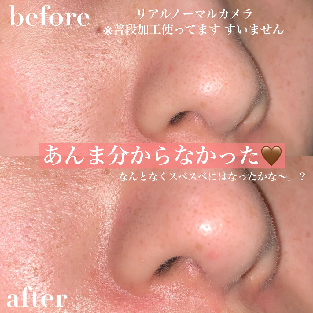 ウォーターピーリング超音波美顔器 Anlanの口コミ はじめてウォーターピーリング わたしはbe By Mana 乾燥肌 代前半 Lips