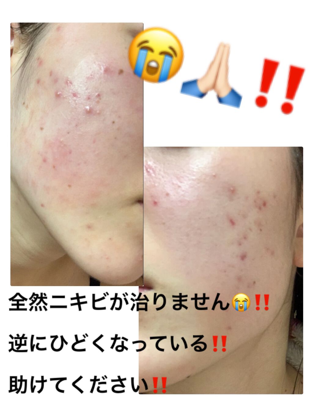 日本酒の化粧水 高保湿 菊正宗を使った口コミ とにかくニキビが酷いです 今高 By すよん 10代後半 Lips