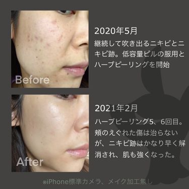 ボタニカルピーリングパウダー ベースジェルlevel1 Botanical Peelの口コミ 混合肌におすすめのピーリング ニキビ肌 ニキビ跡の改 By Maacosme 混合肌 30代前半 Lips