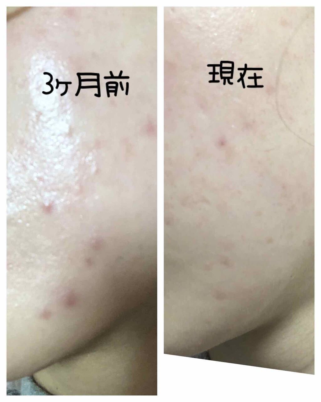 スキンアクティブセラム Orbisを使った口コミ オルビスユーライン使いから3ヶ月経ちました By Helon 敏感肌 代後半 Lips