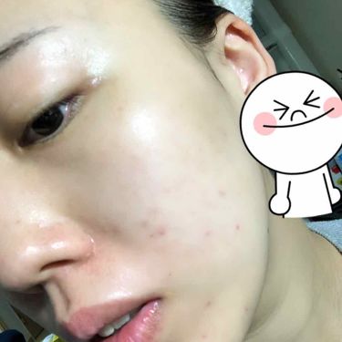 チョコラbbプラス 医薬品 チョコラbbを使った口コミ 半年間の本気肌改革 ニキビと美白につ By からあげさん 混合肌 代前半 Lips