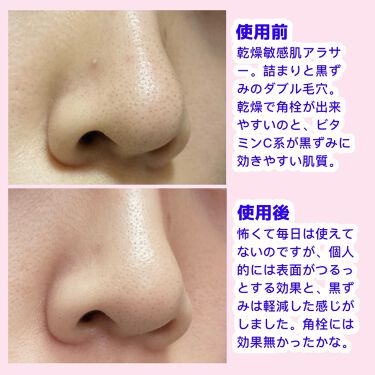 Serum Shot Glow Your Skin Phoebe Beauty Upの効果に関する口コミ あらゆる毛穴悩みに 話題の毛穴美容液 こ By はるいさ 敏感肌 代後半 Lips