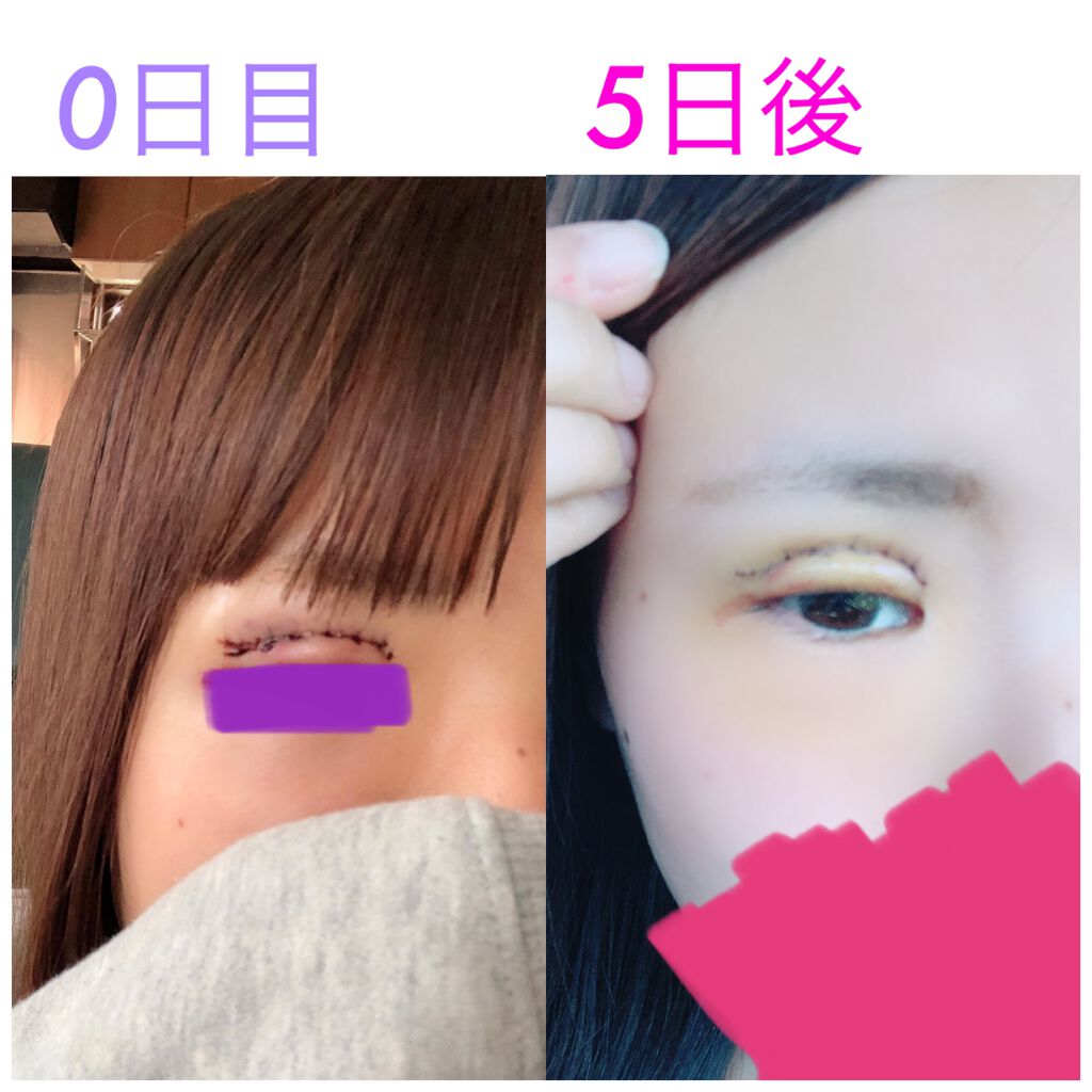 二重整形の口コミ 二重切開について コスメ関係なくてすみま By りほ 代前半 Lips