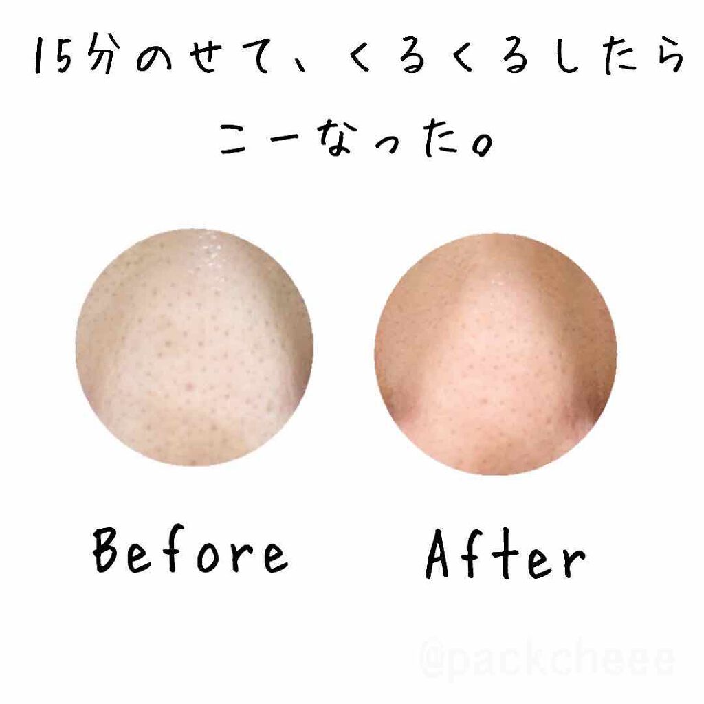 P Z Ssoc Ssoc No More Blackhead One Day S Youの使い方を徹底解説 ぐっばい いちご鼻 One Day Sy By Packcheee 混合肌 30代前半 Lips