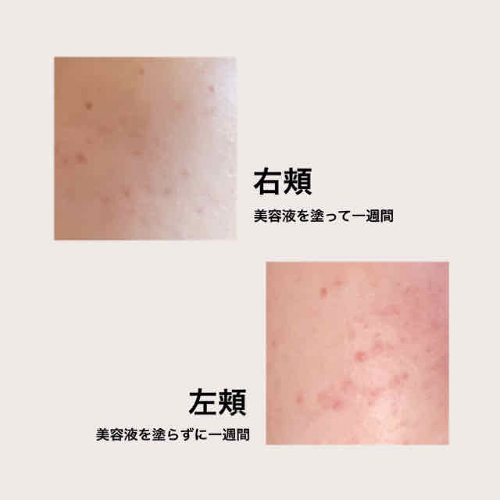 ロゼット洗顔パスタ アクネクリア ロゼットを使った口コミ はじめまして 今回はニキビ跡について 私の By M M 混合肌 Lips