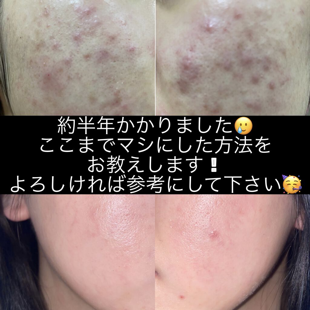 パーフェクトホイップn Senka 専科 を使った口コミ 小学生の頃からなにしても肌荒れが治らなくて By Uri 混合肌 10代後半 Lips