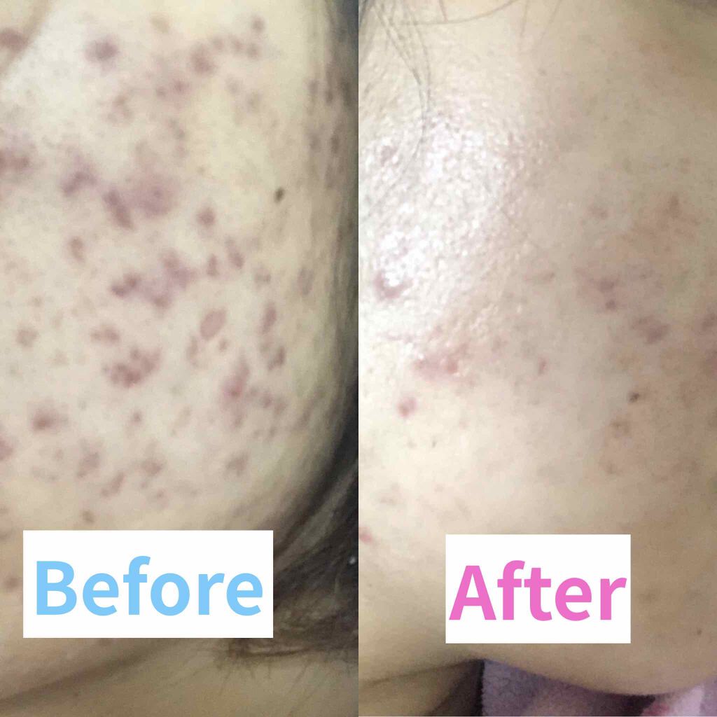 ポア クレンジング パック ファンケルを使った口コミ 2枚目画像閲覧注意 元アトピー肌 超 By ゆりん Lips