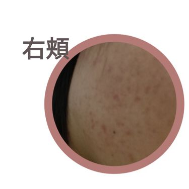 マルチビタミン 栄養機能食品 ビタミンb1 ビタミンc ビタミンe Dhcを使った口コミ 肌荒れとニキビに悩む高校生です 3日目 By ちーちょ 脂性肌 10代後半 Lips