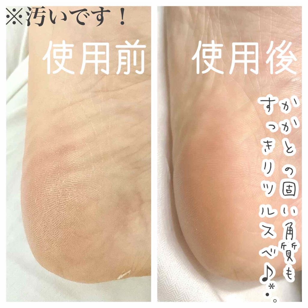 ダブルピーリングプレミアム Myse ミーゼ の使い方を徹底解説 毛穴レス肌へ 肌に優しいウォーターピーリン By ふくこ 混合肌 30代前半 Lips