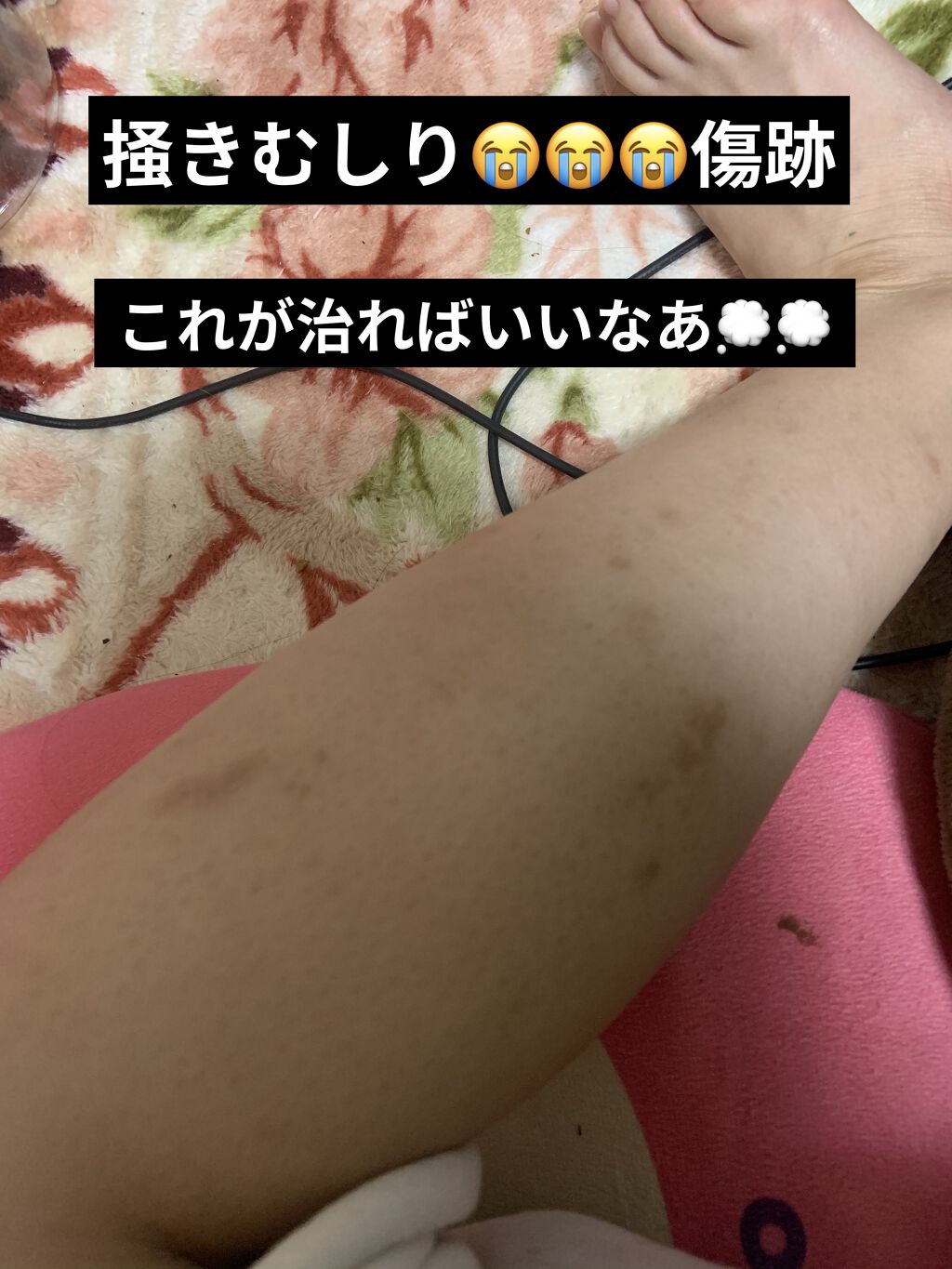 バイオイル バイオイルの口コミ 使い切るまでに傷跡は治るのかチャレンジ By りちゃん 混合肌 Lips