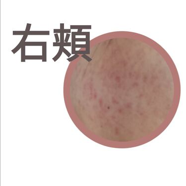 マルチビタミン 栄養機能食品 ビタミンb1 ビタミンc ビタミンe Dhcを使った口コミ 肌荒れとニキビに悩む高校生です 4日目 By ちーちょ 脂性肌 10代後半 Lips