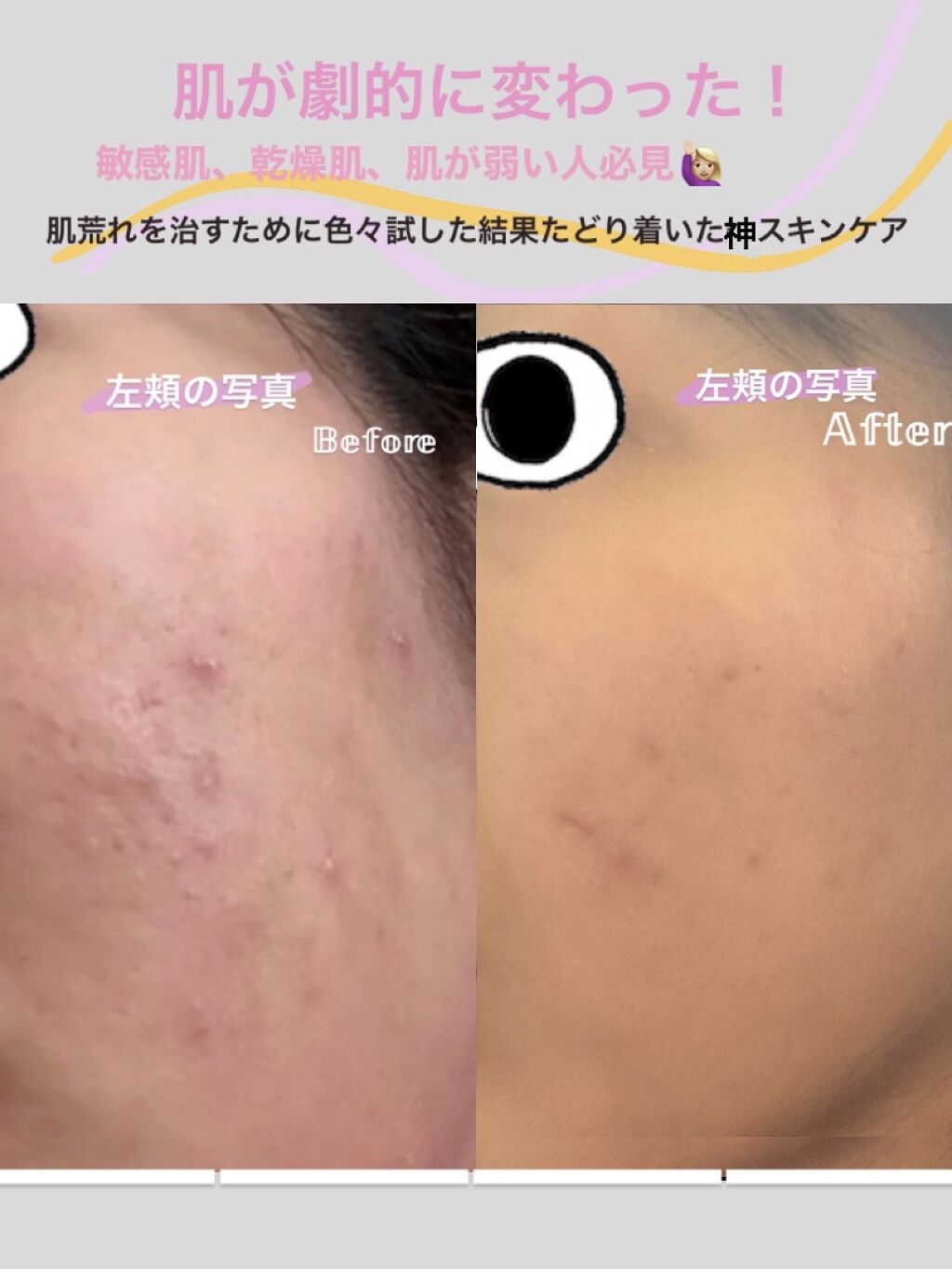 スキンケア方法 薬用 しみ 集中対策 美容液 メンソレータム メラノccの使い方 効果 こんなにも肌荒れが改善 By A Beauty 混合肌 Lips