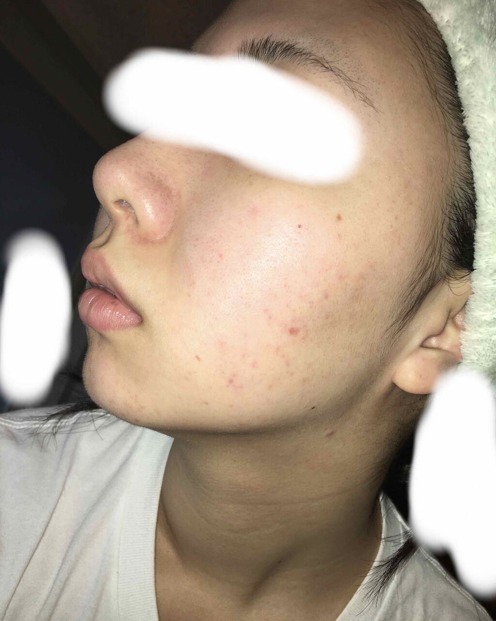 デュアック配合ゲル 医薬品 ポーラファルマの口コミ ニキビ跡に効くもの教えてください 最近の肌 By フワフワネコチャン 乾燥肌 10代後半 Lips