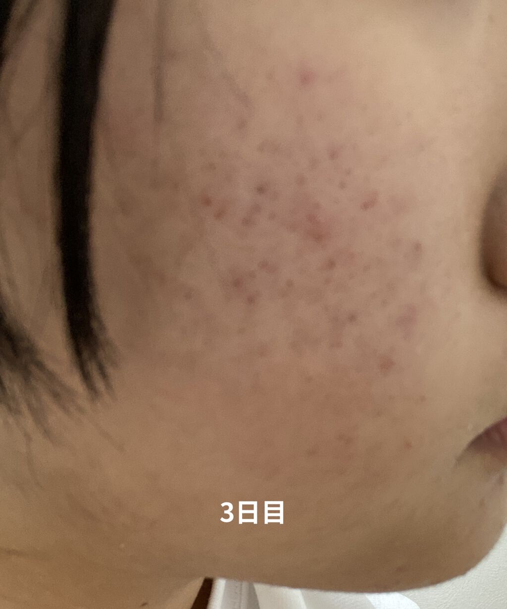 白色ワセリン 医薬品 健栄製薬の口コミ 1週間でニキビ跡が薄くなった 白色ワセ By Orange Lips Nez 10代前半 Lips