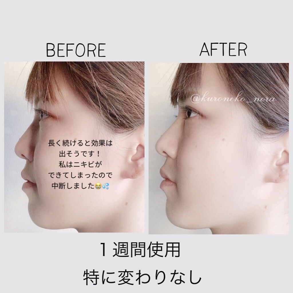 ノーズトレーナー Daisoの辛口レビュー 110円で 鼻を高くできるのか 評価見 By ルーシー 乾燥肌 代前半 Lips