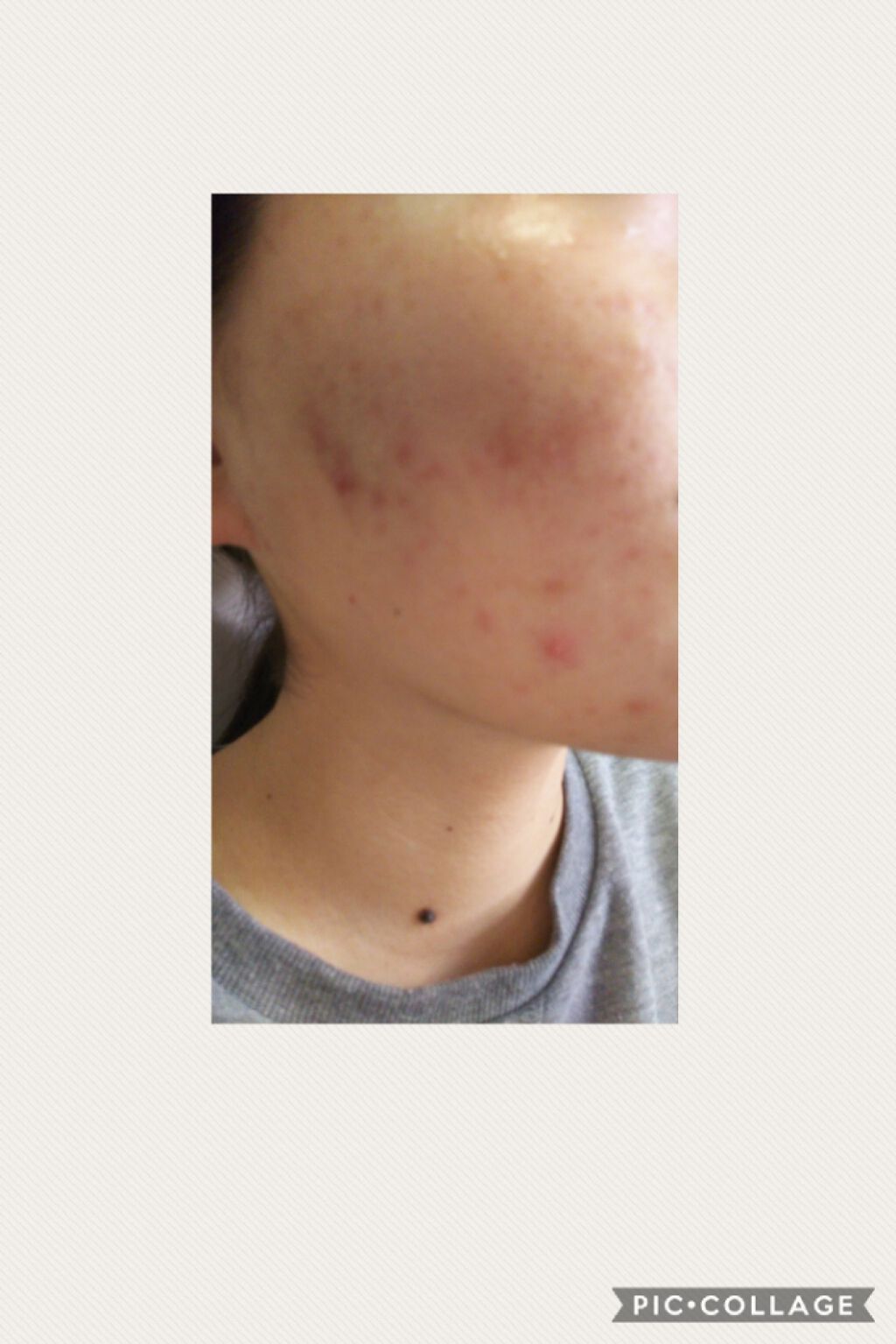 デュアック配合ゲル 医薬品 ポーラファルマの口コミ お久しぶりです ユキです 今回からニキビ治 By ゆき 乾燥肌 Lips