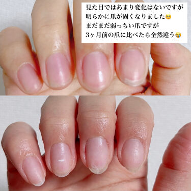 デイケアオイル Dr Nailの口コミ 爪の縦線亀裂で悩んでいる方へ 是非ご覧くだ By R E N A𓂃𓈒𓏸 混合肌 代前半 Lips デイケアオイル Dr Nailの口コミ 爪の縦線亀裂で悩んでいる方へ 是非ご覧くだ By R E N A𓂃𓈒𓏸 混合肌 代前半 Lips