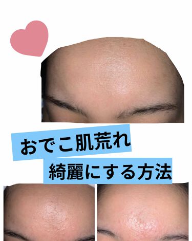 スキンケア方法 ミノン アミノモイスト モイストチャージ ローションii もっとしっとりタイプ ミノンの使い方 効果 おでこの肌荒れに悩む方 By 美容に目がない 乾燥肌 10代後半 Lips