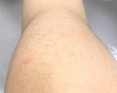 ラグジュアリーオイルケア 除毛クリーム エピラットの使い方を徹底解説 閲覧注意 除毛前の画像が2枚目からあります By Sleep 敏感肌 10代後半 Lips