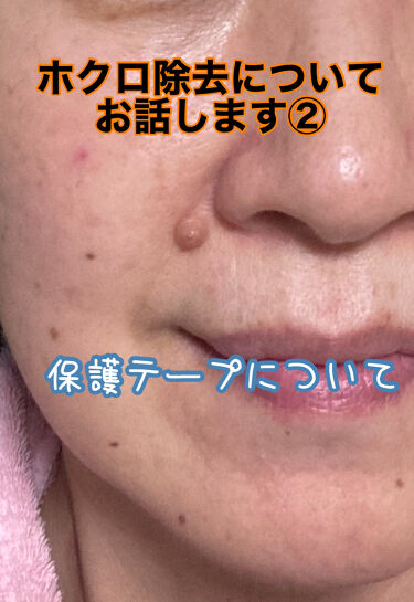 1000円以下 キズを早くきれいに治すパッチ Matsukiyoのリアルな口コミ レビュー Lips