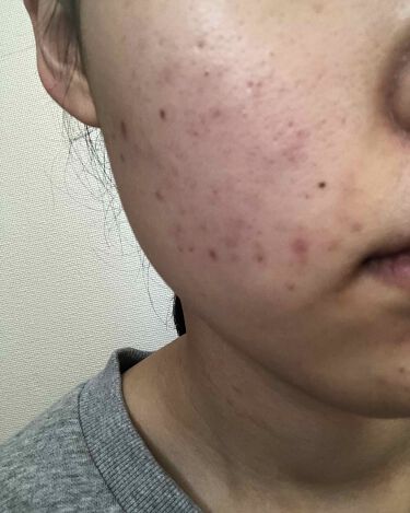 ベピオゲル 医薬品 の口コミ これからニキビ ニキビ跡を治せるように頑張 By まい 脂性肌 10代後半 Lips