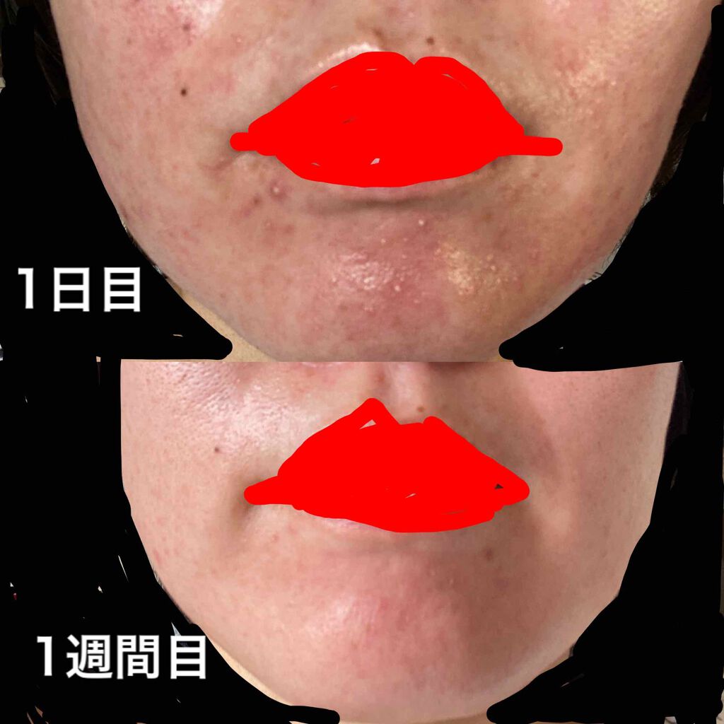 ベピオゲル 医薬品 の口コミ こんにちは 休校になり 私なん By Amin 敏感肌 30代前半 Lips