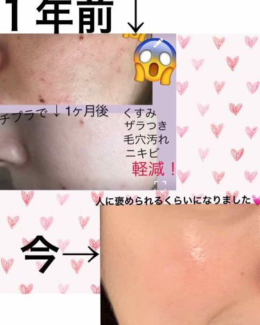 ミノン アミノモイスト 薬用アクネケア ローション ミノンのリアルな口コミ レビュー Lips