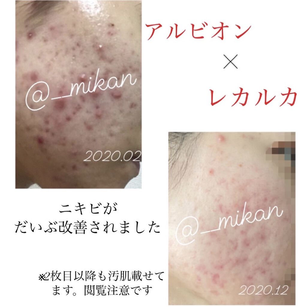 アルビオン 薬用スキンコンディショナー エッセンシャル Albionを使った口コミ 消えてしまったので再投稿です ニキビ By Nanoha 乾燥肌 代前半 Lips