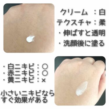 ペアアクネクリームw 医薬品 ペアの効果に関する口コミ 乾燥肌におすすめのスキンケア ニキビ対策 ライオン By ねねむ 混合肌 代後半 Lips