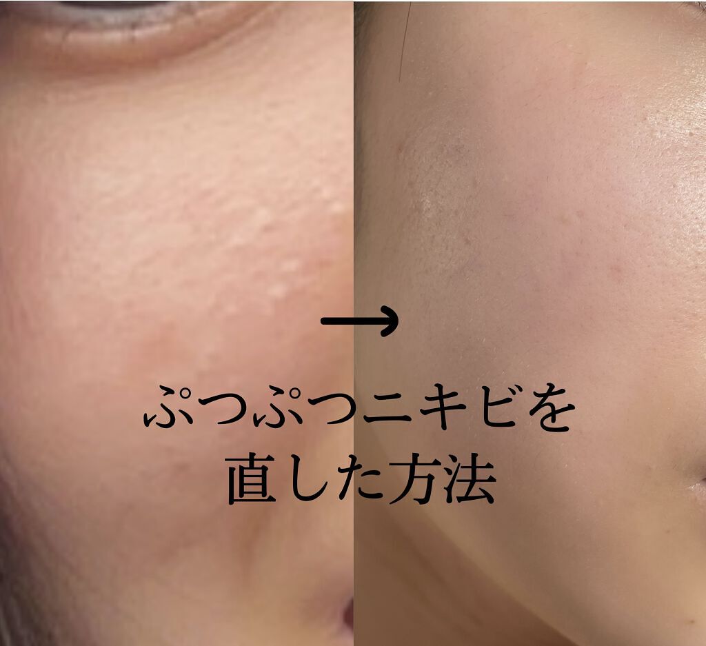 スキンケア方法 化粧水 敏感肌用 しっとりタイプ 無印良品の使い方 効果 私がぷつぷつニキビを By あぷりこっと 敏感肌 10代後半 Lips