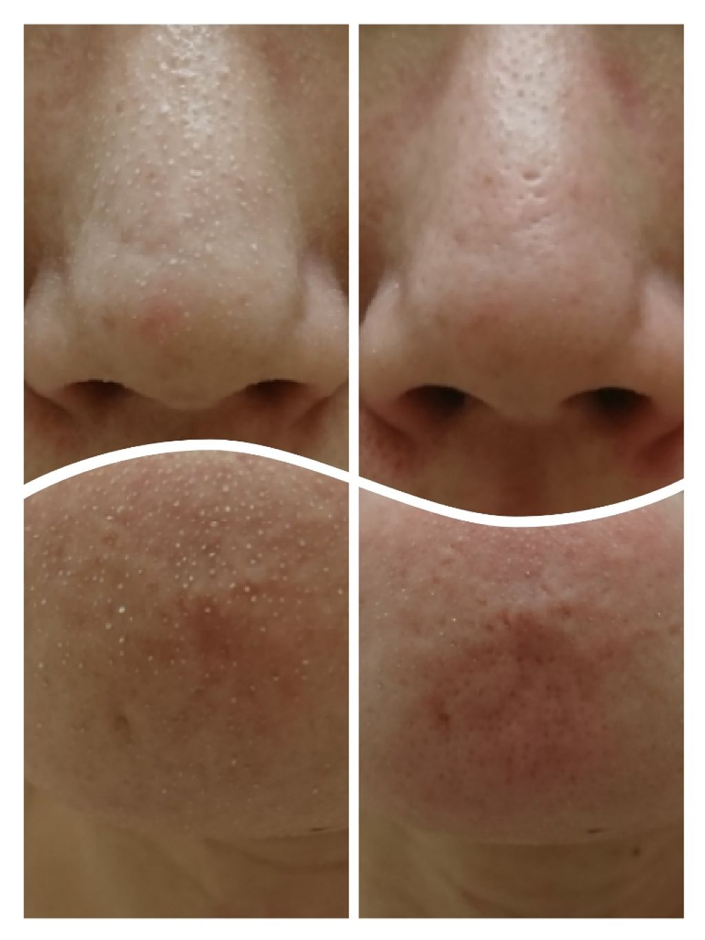 All Kill Blackhead Remover Stick Rireの効果に関する口コミ 結論 By カピ みかん肌代表 乾燥肌 代後半 Lips