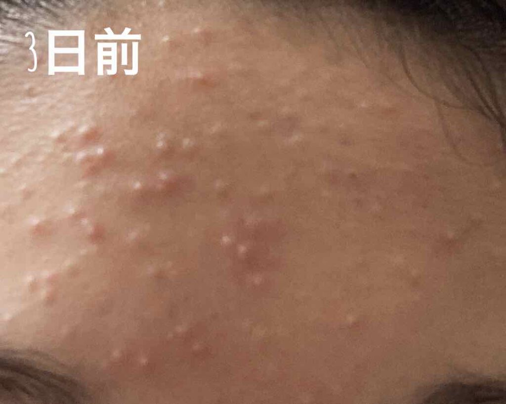 ナチュリエ ハトムギ保湿ジェル ナチュリエ スキンコンディショニングジェル ナチュリエを使った口コミ この4つ本当に優秀です 3日でここまで減り By 真愛 脂性肌 10代後半 Lips