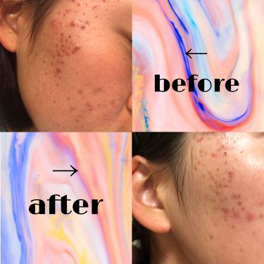 バイオイル バイオイルの辛口レビュー バイオイル3枚目注意 ニキビ跡に効くという By Lips