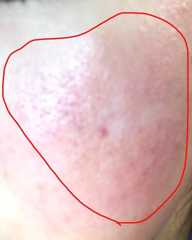 明色 美顔水 薬用化粧水 明色化粧品を使った口コミ ニキビ治りました やったー って思っ By ちょこ 敏感肌 10代前半 Lips