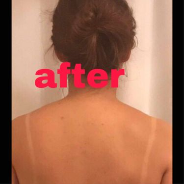 ベピオゲル 医薬品 を使った口コミ ニキビ ニキビ跡治療について 歳から By ちでじ Lips