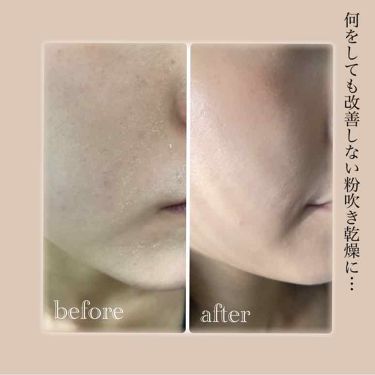 薬用バーム Ihadaの口コミ 乾燥肌におすすめのフェイスバーム 写真はbefore By 乾燥肌 代前半 Lips
